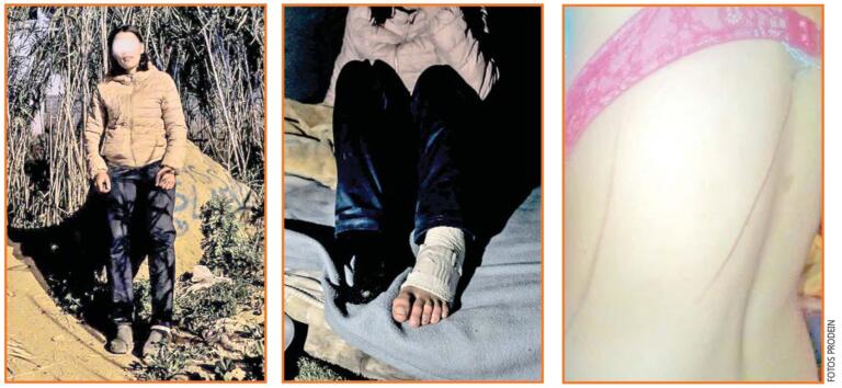 Distintas imágenes de “Rachida” (nombre ficticio de la joven) con las heridas sufridas por agresiones y un “riski”