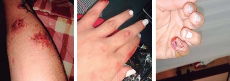 Heridas en los brazos y en las manos. Ha llegado a perder parte de un dedo